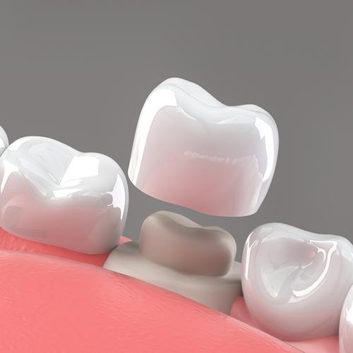 كل ما تحتاج معرفته عن تركيبات الأسنان &ndash; من صفوة المهيدب