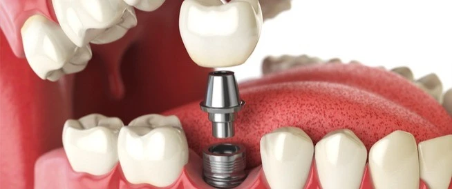 الفرق بين زراعة الأسنان وجسور الأسنان في عيادات صفوة المهيدب