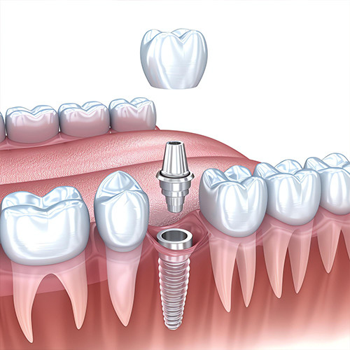 زراعة الاسنان